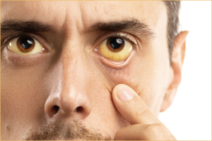 Man with alcohol liver diseased yellow eyes